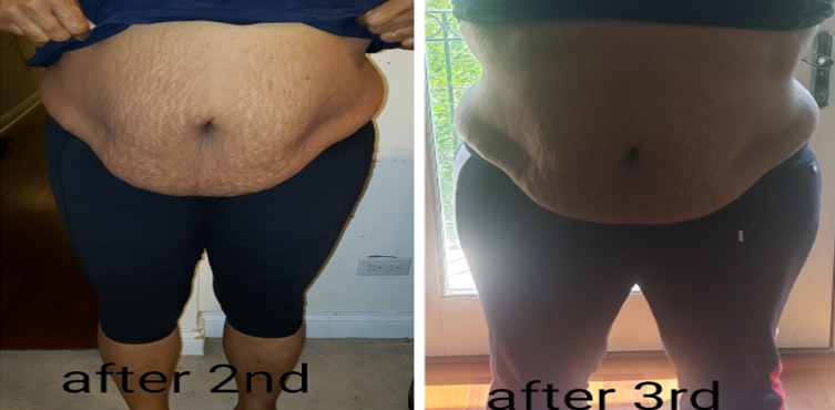 Laser Fat Reduction Near Chicago